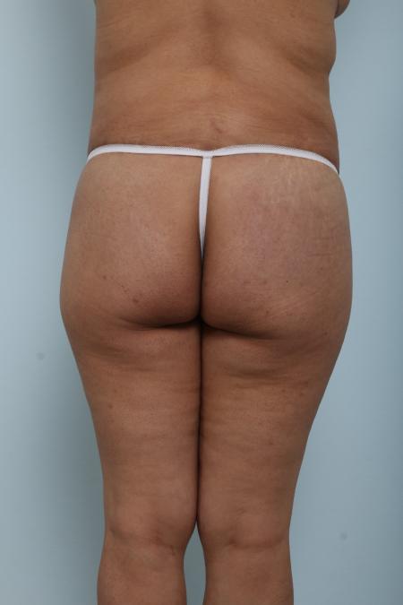 After image 4 Case #125921 - Body Lift