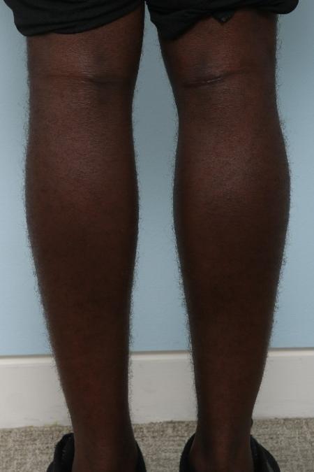 After image 2 Case #125946 - Calf Implants