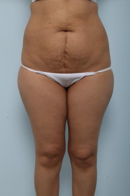 Before image 1 Case #125991 - Tummy Tuck