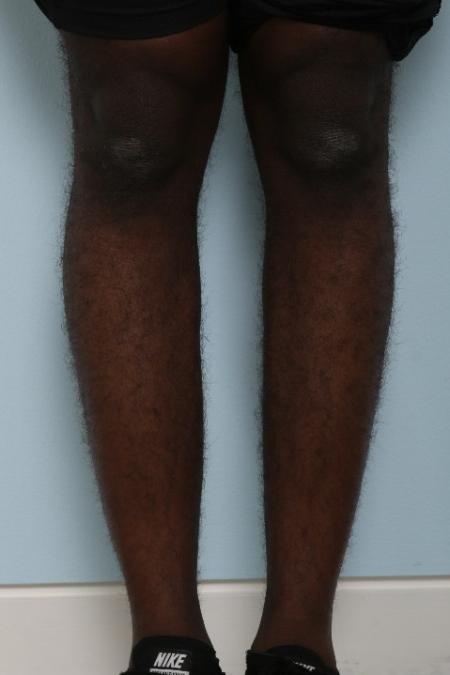 Before image 1 Case #125946 - Calf Implants