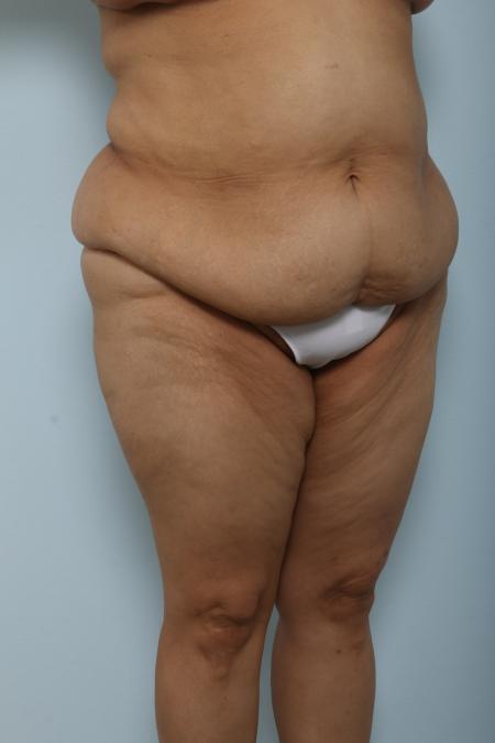 Before image 2 Case #125921 - Body Lift