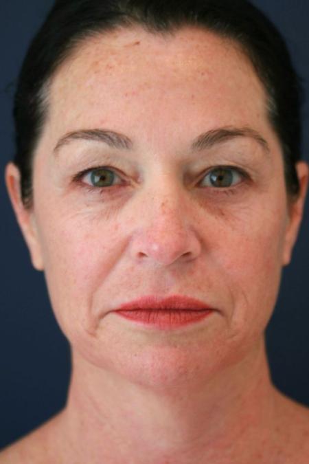 Before image 1 Case #125656 - Co2 Laser Resurfacing