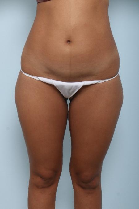 Before image 1 Case #125971 - Liposuction