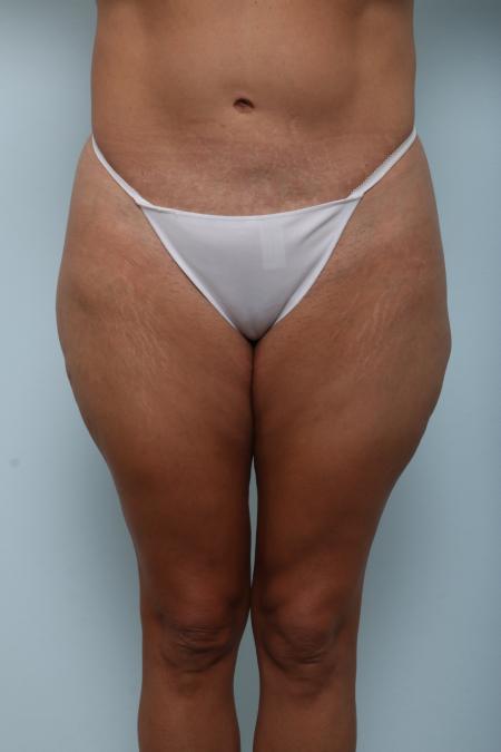 After image 1 Case #125976 - Body Lift