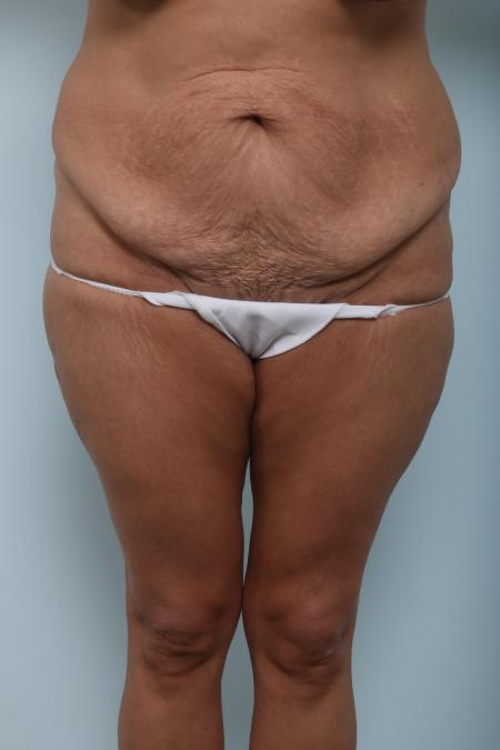 Before image 1 Case #125976 - Body Lift