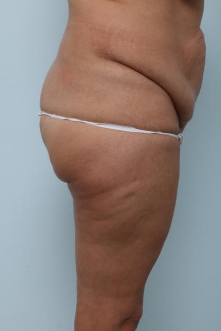 Before image 3 Case #125976 - Body Lift