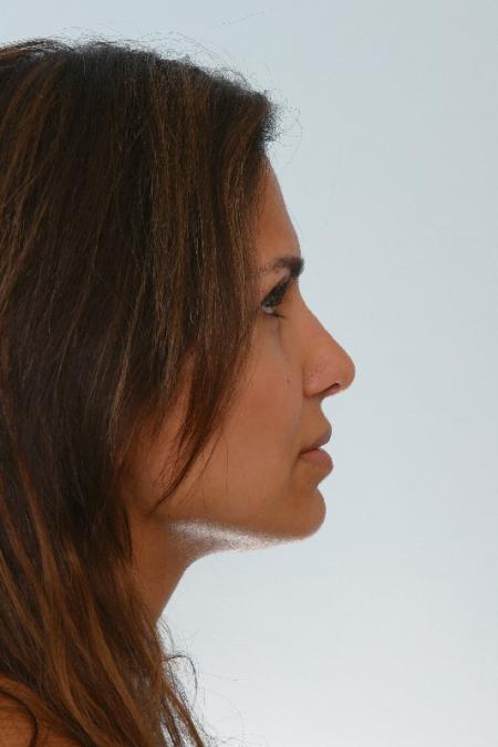 After image 2 Case #125901 - Rhinoplasty