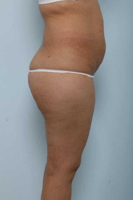 Before image 3 Case #125991 - Tummy Tuck
