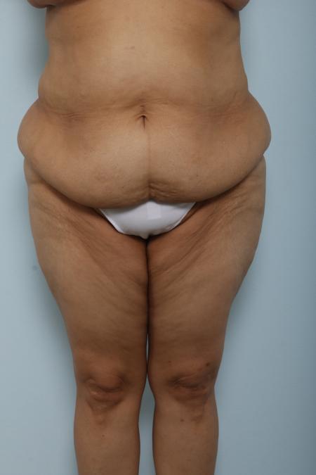 Before image 1 Case #125921 - Body Lift