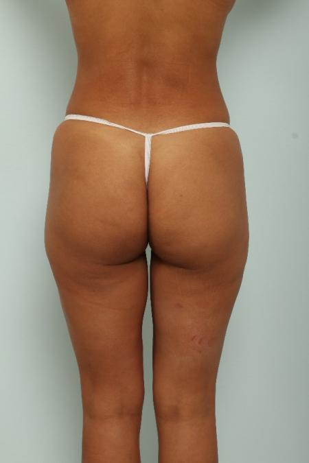 After image 4 Case #125971 - Liposuction
