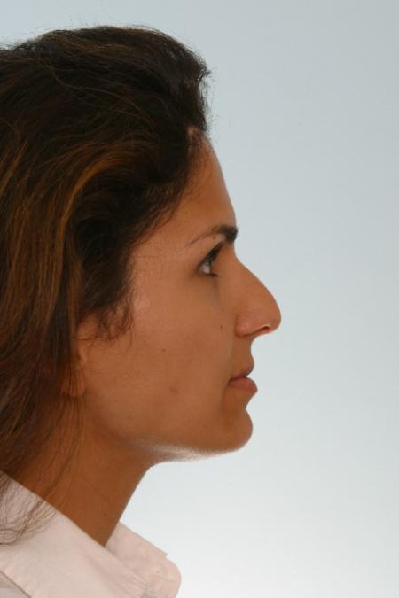 Before image 2 Case #125901 - Rhinoplasty