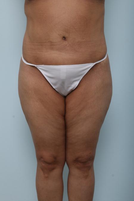 After image 1 Case #125921 - Body Lift