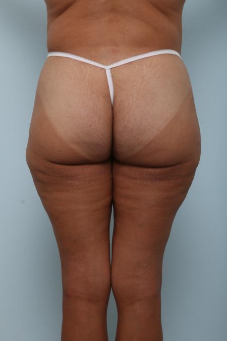 After image 4 Case #125976 - Body Lift