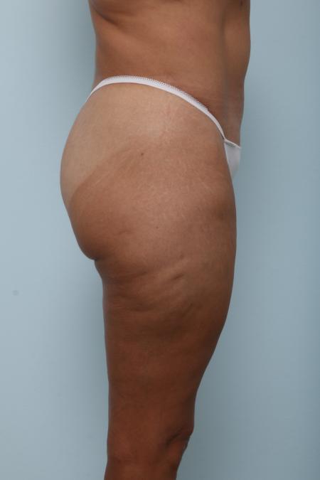 After image 3 Case #125976 - Body Lift