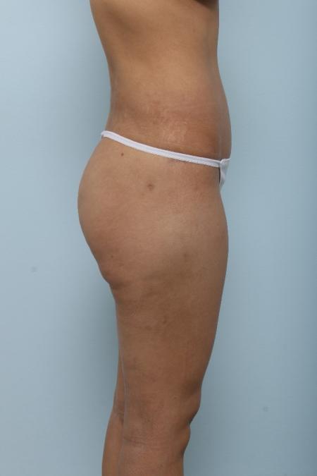 After image 3 Case #125991 - Tummy Tuck