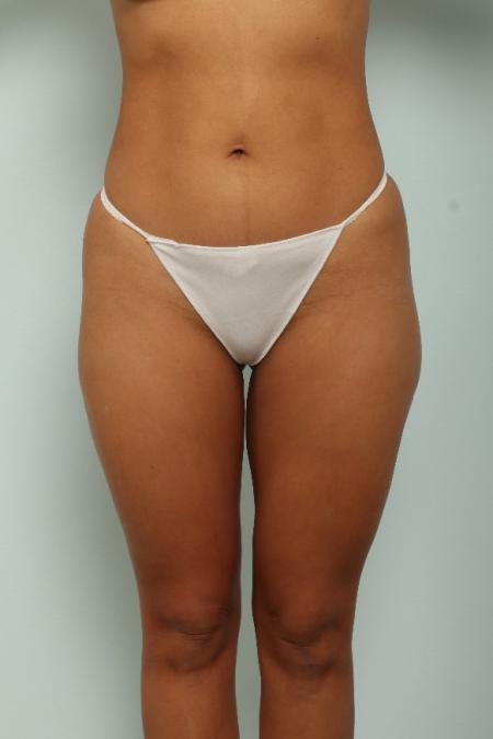 After image 1 Case #125971 - Liposuction