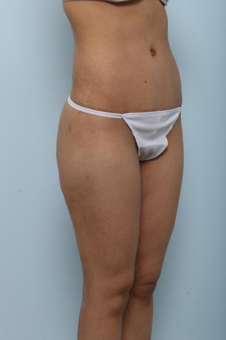 After image 2 Case #125991 - Tummy Tuck