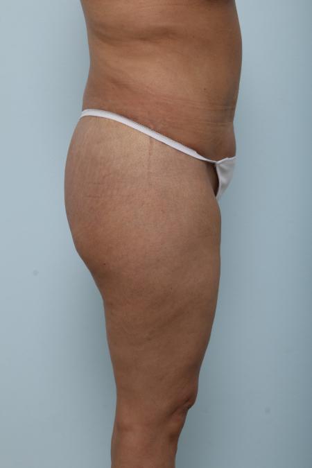 After image 3 Case #125921 - Body Lift
