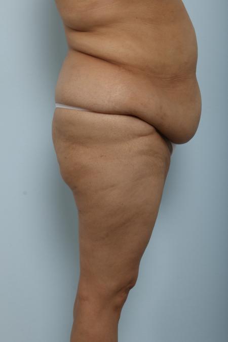 Before image 3 Case #125921 - Body Lift