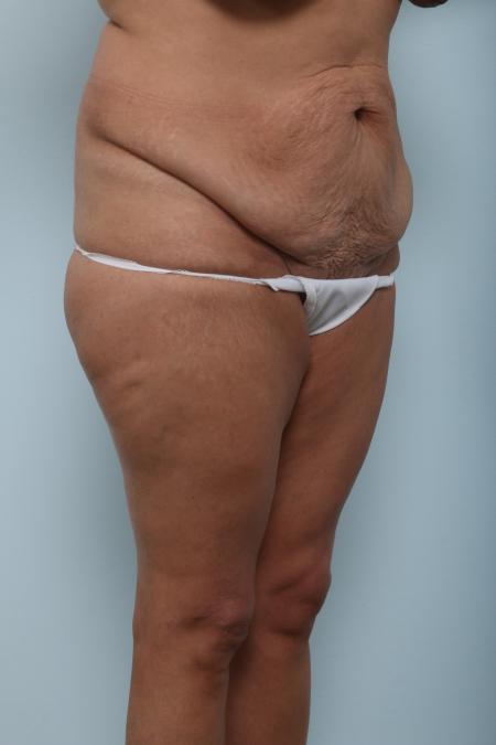 Before image 2 Case #125976 - Body Lift