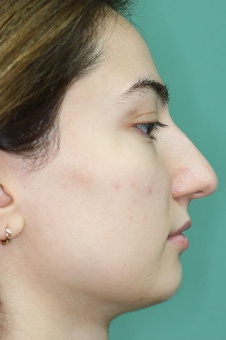 Before image 5 Case #126811 - Reduction Rhinoplasty