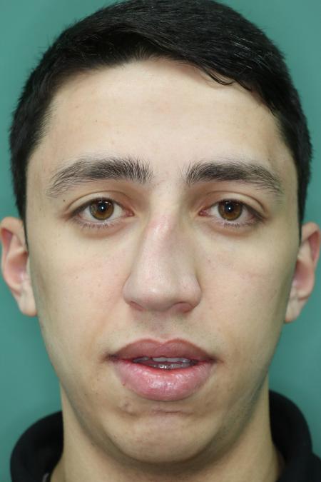 Before image 1 Case #126756 - Nasal Deviation Syndrome