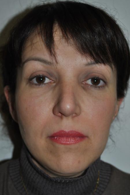 After image 1 Case #126781 - Aesthetic Reduction Rhinoplasty