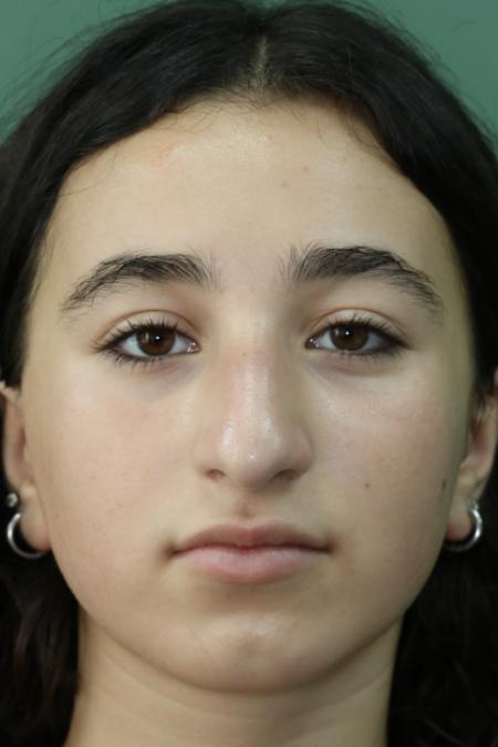 Before image 1 Case #126786 - Nasal Deviation Syndrome