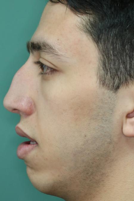 Before image 5 Case #126756 - Nasal Deviation Syndrome