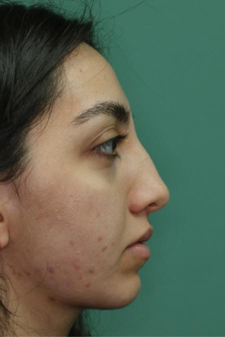 Before image 4 Case #126796 - Nasal Deviation Syndrome. Rhinogenic Headache 