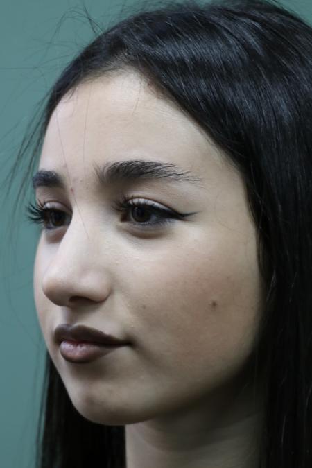 After image 3 Case #126786 - Nasal Deviation Syndrome