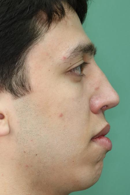 After image 4 Case #126756 - Nasal Deviation Syndrome