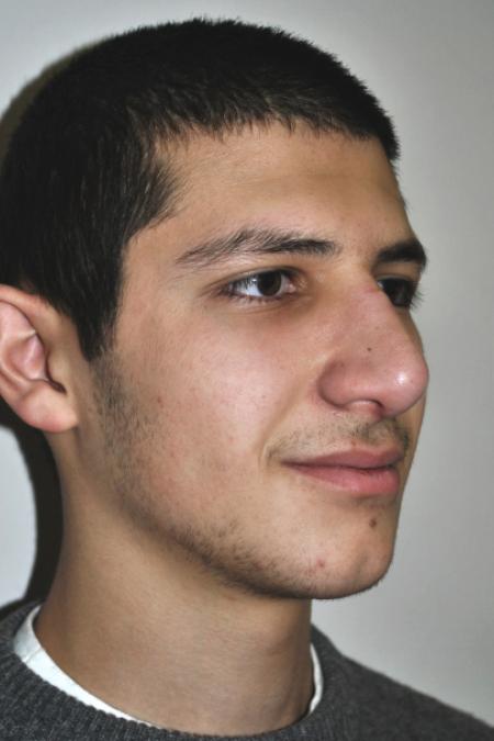 After image 2 Case #126761 - Primary Rhinoplasty