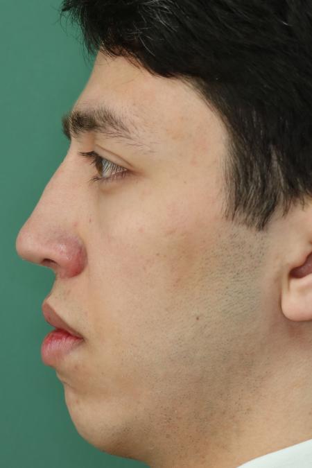 After image 5 Case #126756 - Nasal Deviation Syndrome