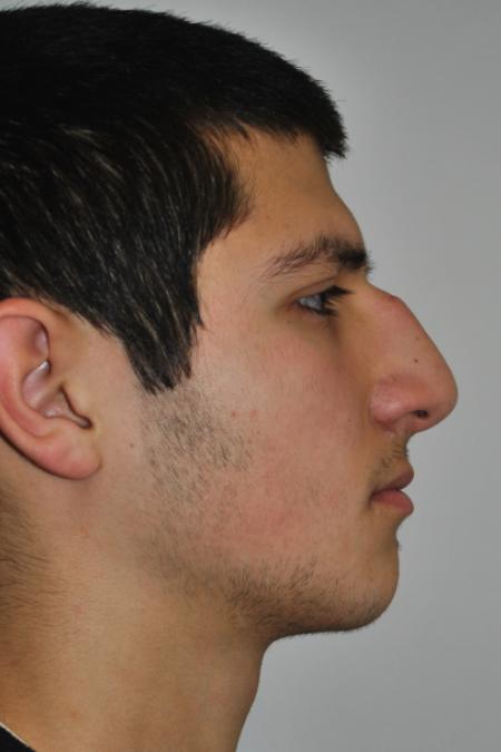 Before image 4 Case #126761 - Primary Rhinoplasty