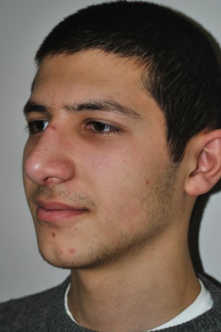After image 3 Case #126761 - Primary Rhinoplasty