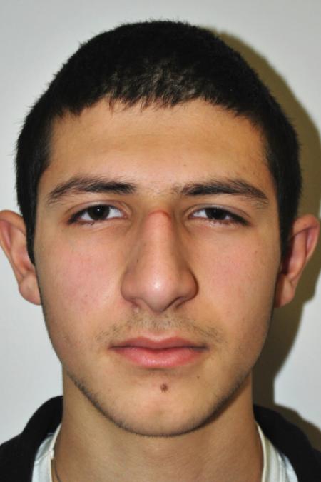 Before image 1 Case #126761 - Primary Rhinoplasty