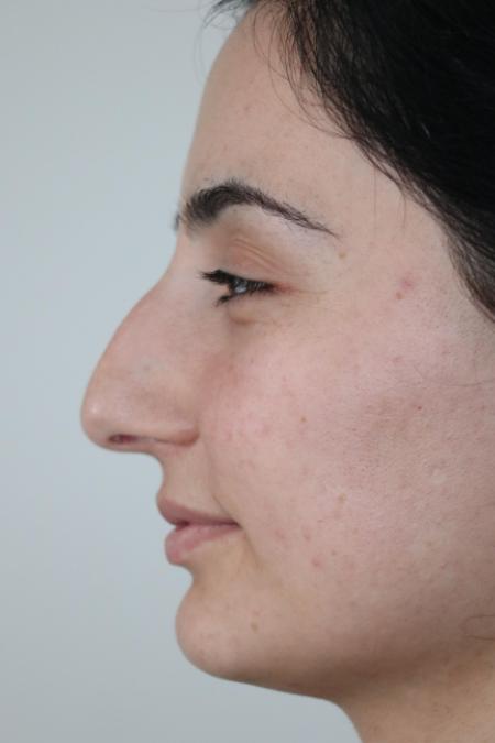 Before image 5 Case #122581 - Primary Rhinoplasty