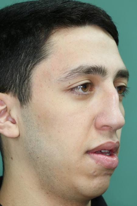 Before image 2 Case #126756 - Nasal Deviation Syndrome
