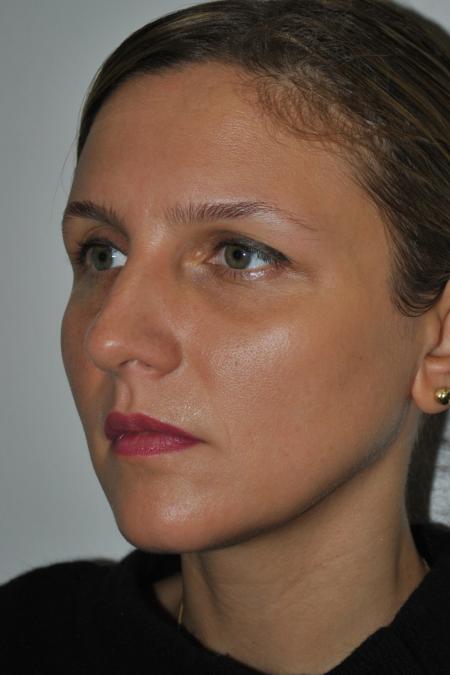 Before image 2 Case #126766 - Nasal Deviation Syndrome