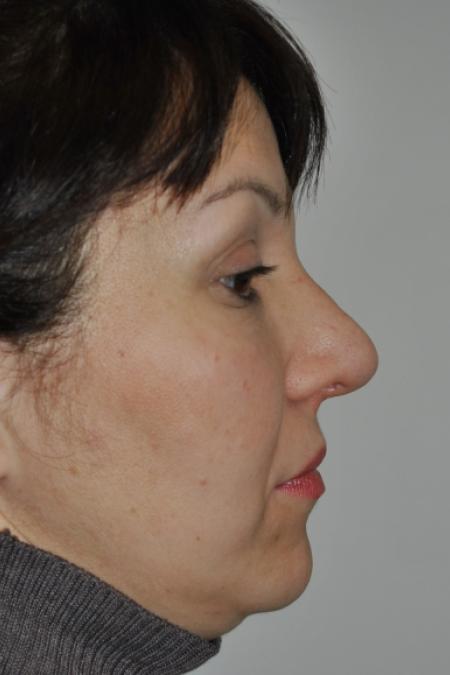 After image 4 Case #126781 - Aesthetic Reduction Rhinoplasty