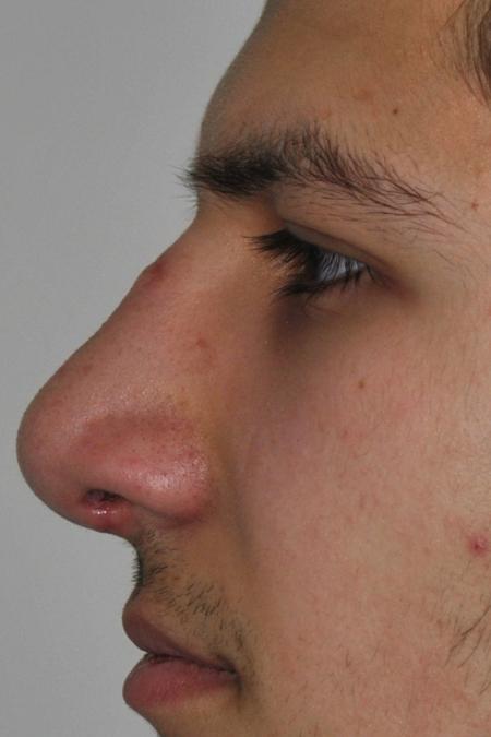 After image 5 Case #126761 - Primary Rhinoplasty