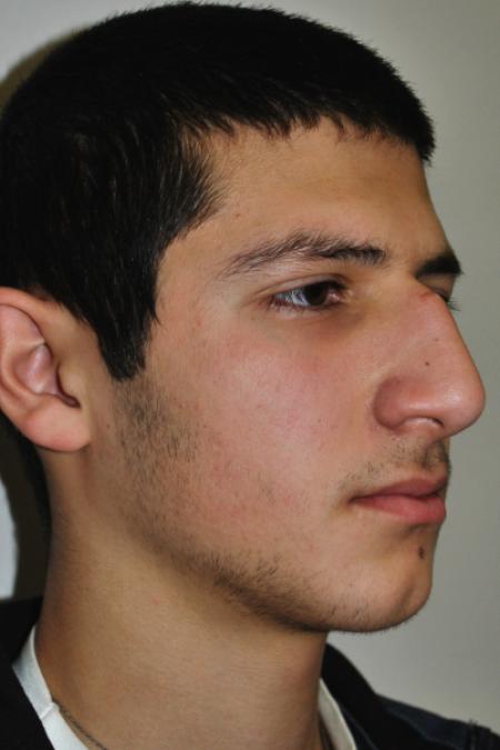 Before image 2 Case #126761 - Primary Rhinoplasty