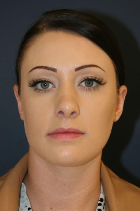 After image 1 Case #126241 - Female Rhinoplasty