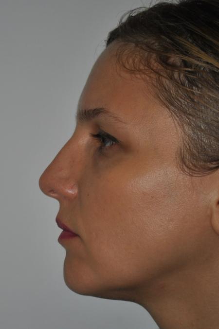 Before image 5 Case #126766 - Nasal Deviation Syndrome