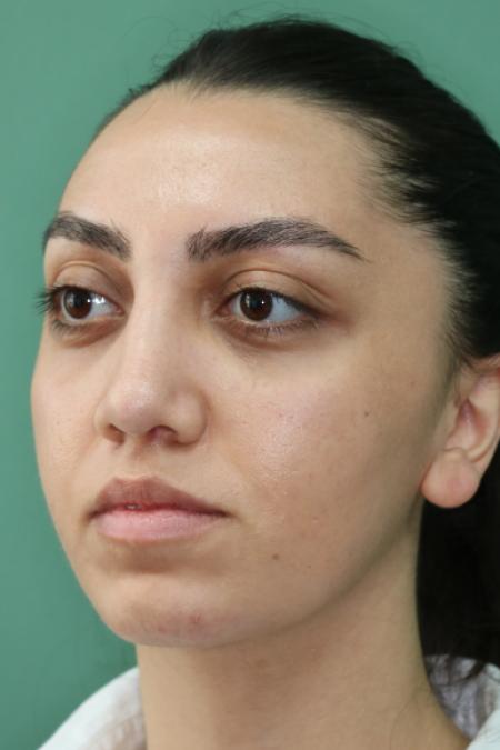 After image 2 Case #126796 - Nasal Deviation Syndrome. Rhinogenic Headache 