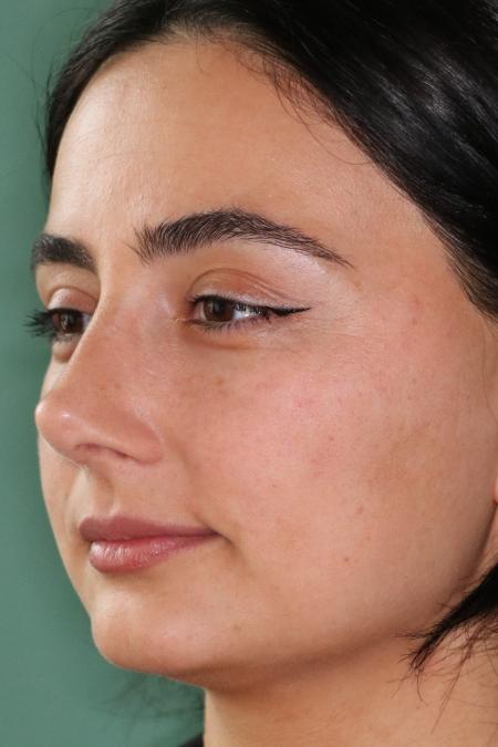 After image 3 Case #122581 - Primary Rhinoplasty