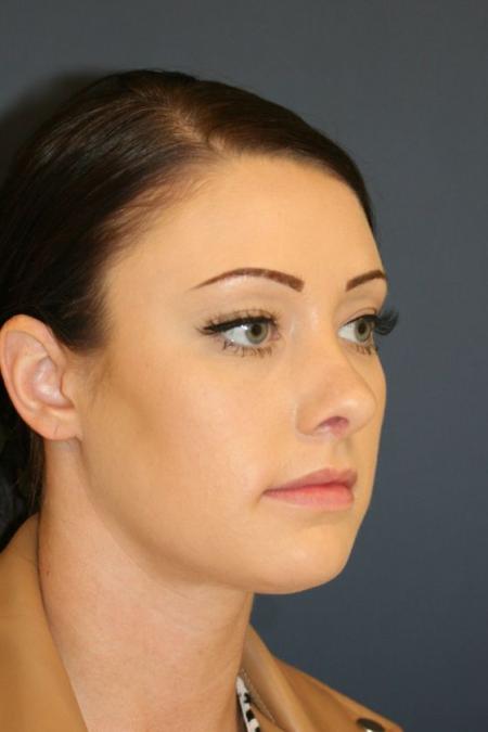 After image 2 Case #126241 - Female Rhinoplasty