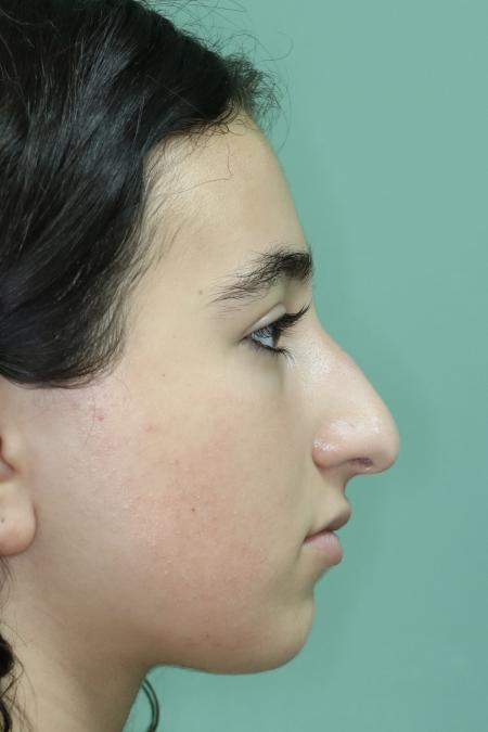 Before image 4 Case #126786 - Nasal Deviation Syndrome