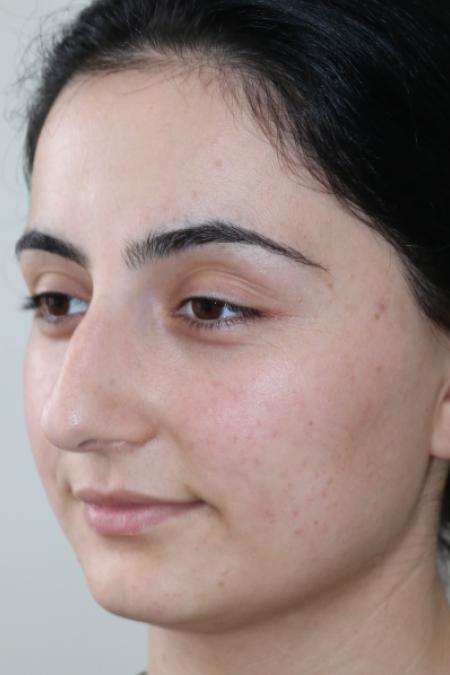 Before image 3 Case #122581 - Primary Rhinoplasty